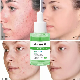  Private Label Organic Facial Skin Care Acne Spots Clearing Skin Soothing Scar Fading Anti Acne Serum